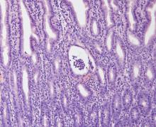 Crypt abscess in the intestinal mucosa as a consequence of unresolved endoplasmic reticulum stress due to hypomorphic XBP1 function (H&E staining